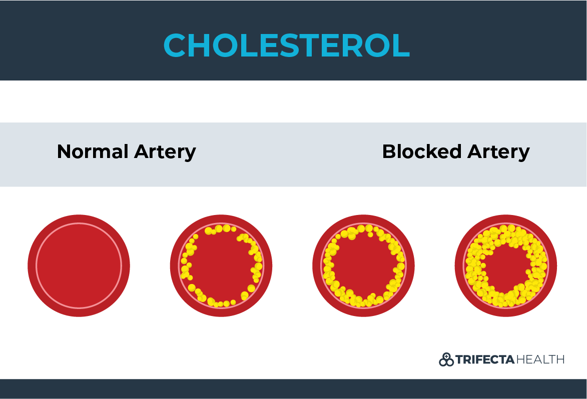 High Cholesterol & 5 Ways to Lower Your Cholesterol Levels